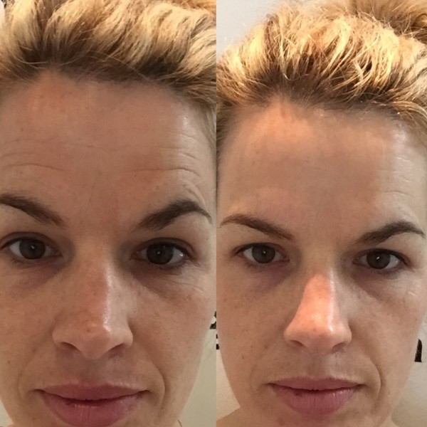 Is it Time For Botox?!