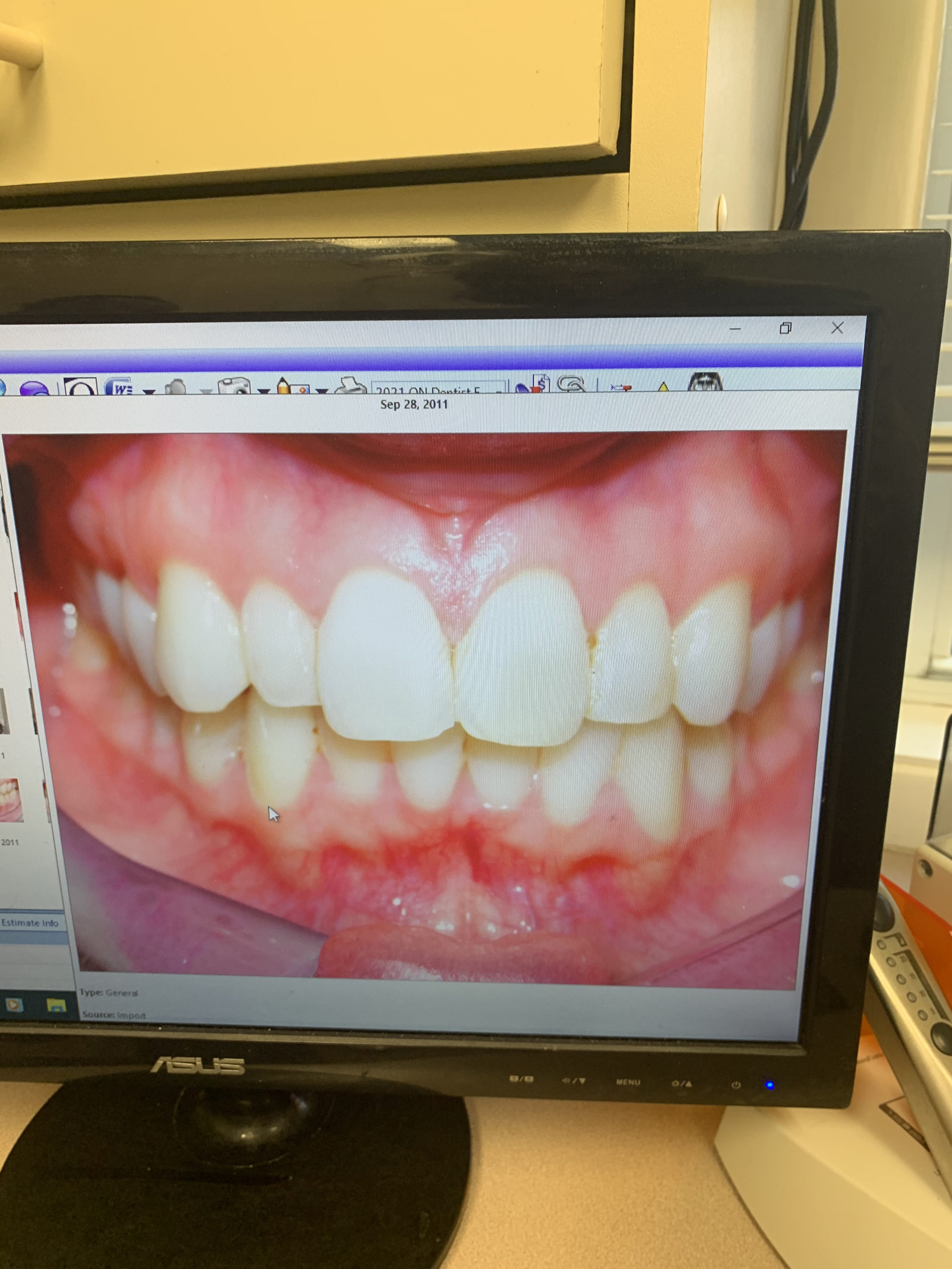 veneers