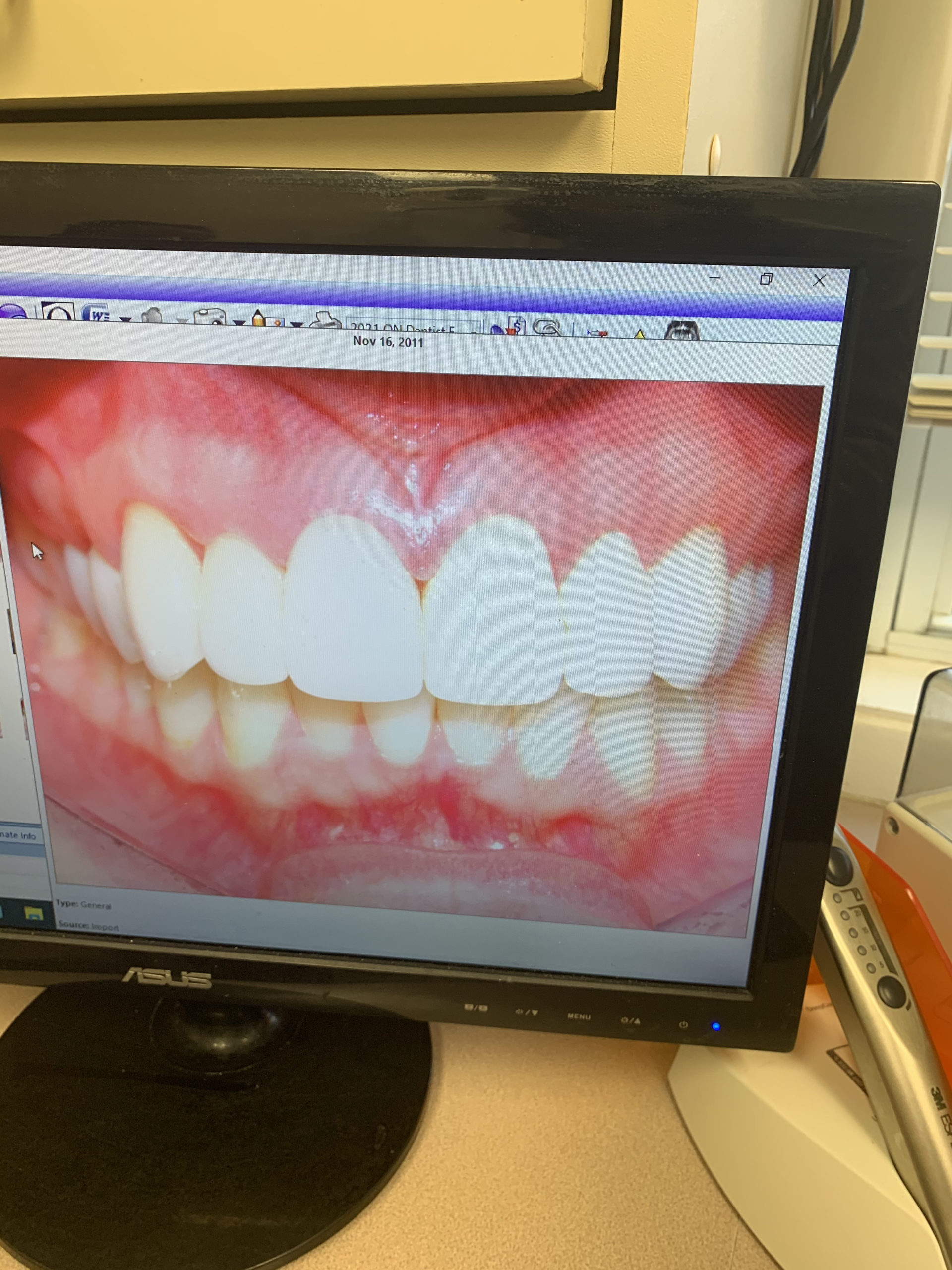 veneers