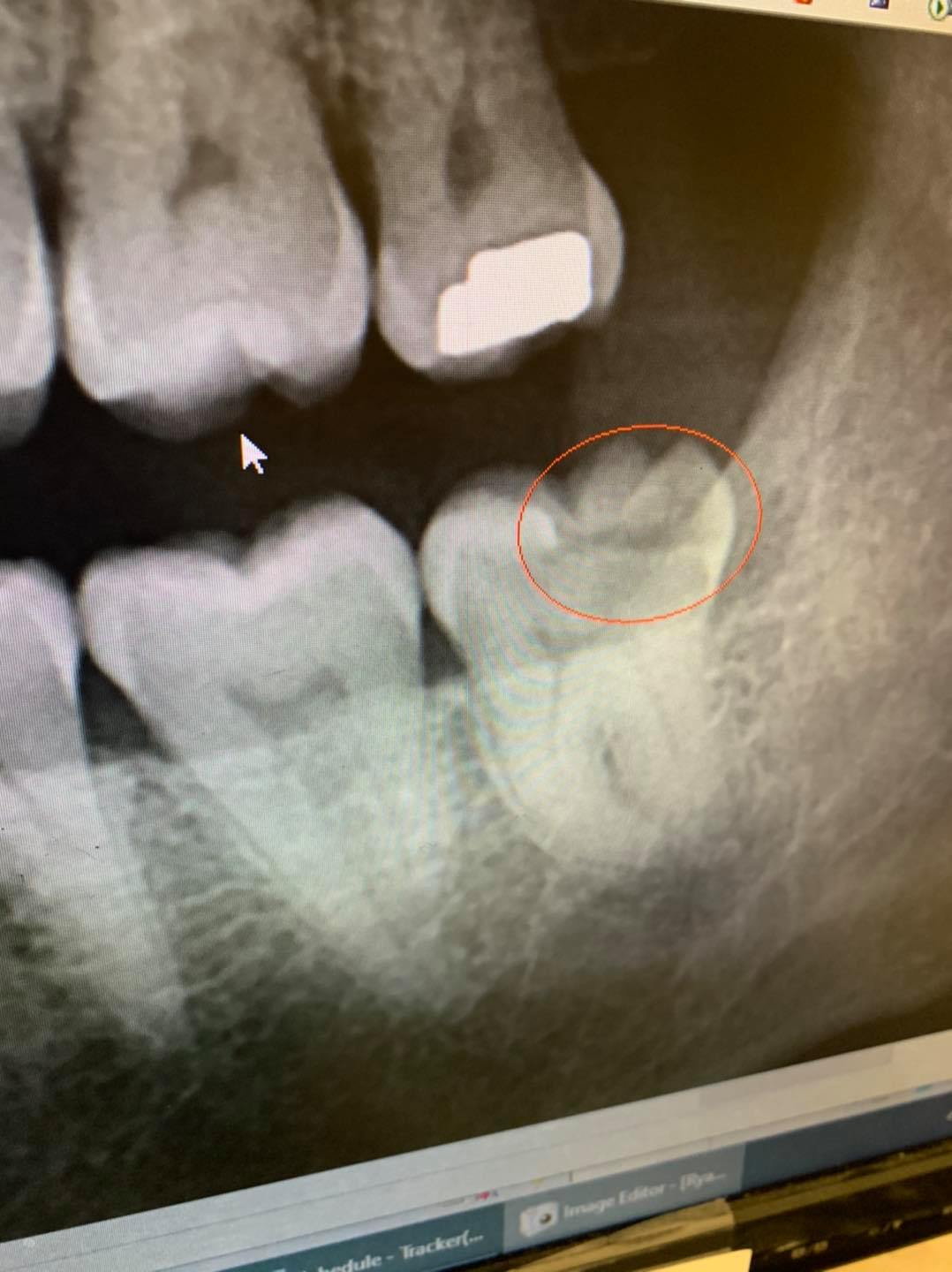 Why Is Nitrous Oxide Used During Dental Procedures?